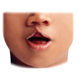 Cleft lip