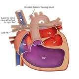 HLHS Stage 2 Repair Illustration