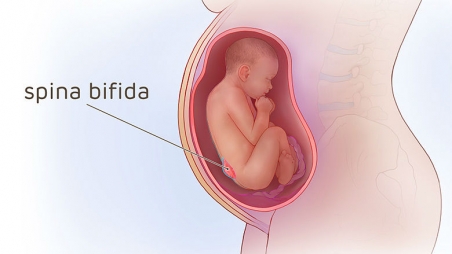 Illustration of mother and fetus with spina bifida