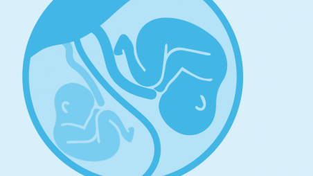 Twin-twin Transfusion Syndrome Illustration, twins in utero