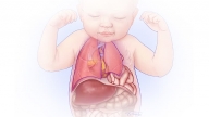 Illustration of CDH showing abdominal organs moving into chest