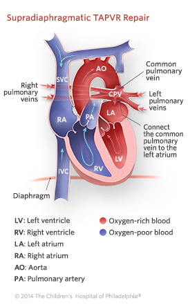 Supracardiac TAPVR Repair Illustration