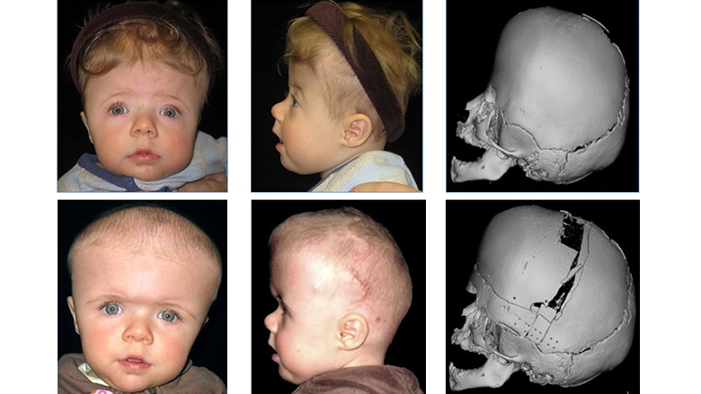 Patient pre- and post- bilateral fronto-orbital advancement