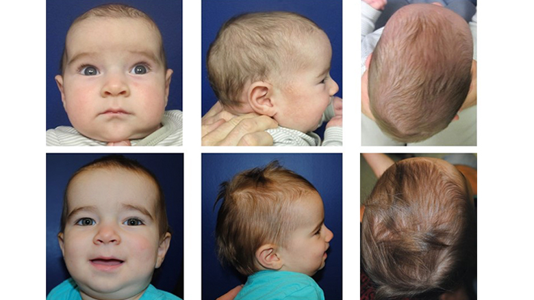 Patient pre- and post- cranial spring procedure