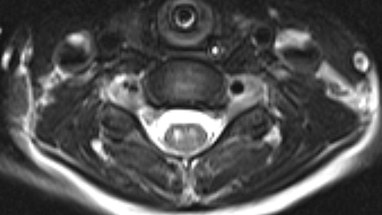 Image of abnormality of gray matter in the cervical spinal cord Image of abnormality of gray matter in the cervical spinal cord
