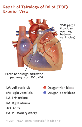 Tetralogy of Fallot Repair Illustration