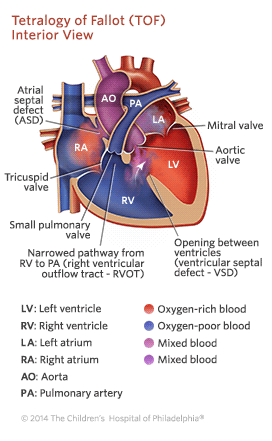 Tetralogy of Fallot Illustration