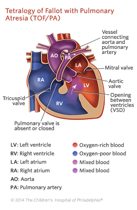 Tetralogy of Fallot with Pulmonary Atresia Illustration