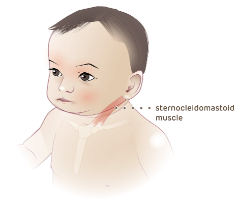 Illustration of infant, callout of the sternocleidomastoid muscle