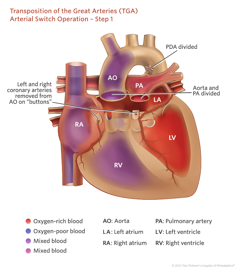 presentation transposition of great arteries