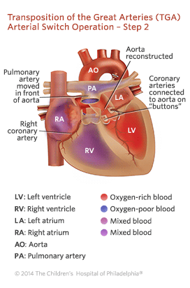 Transposition of the Great Arteries Arterial Switch Operation - Step 2 Illustration