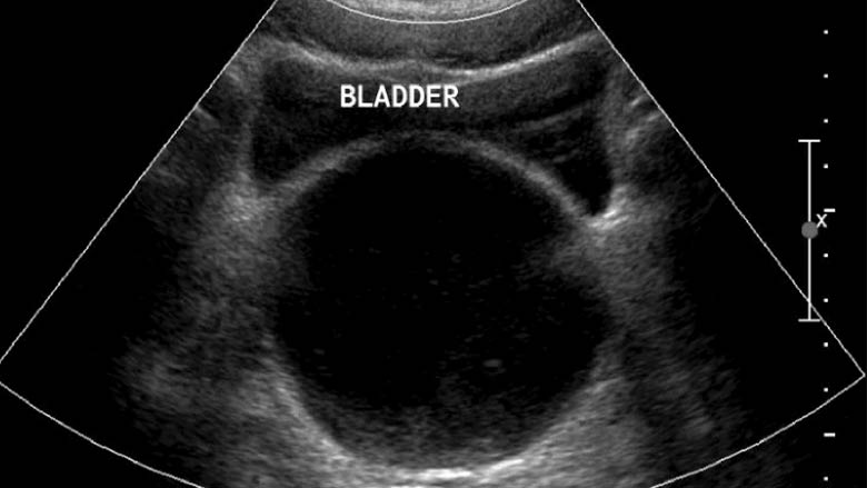 Transverse Vaginal Septum Cause of Urinary Retention Ultrasound