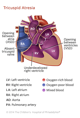 tricuspid atresia