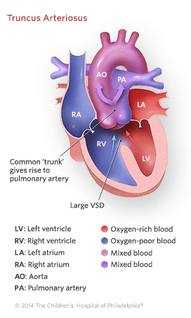 Truncus Arteriosus Illustration