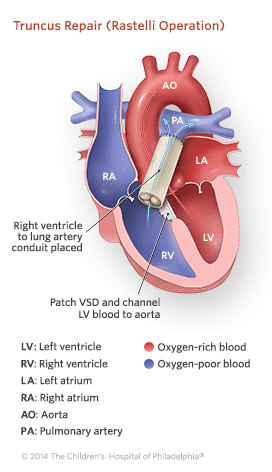 Truncus Arteriosus Repair Illustration