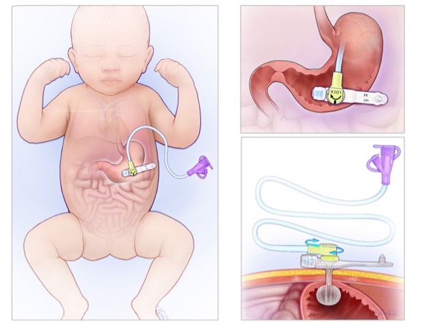 Illustration of with tube in stomach