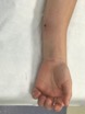 Type 1 Fracture