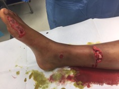 Type 2 Fracture