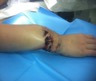 Type 3A Fracture