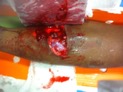 Type 3B Fracture