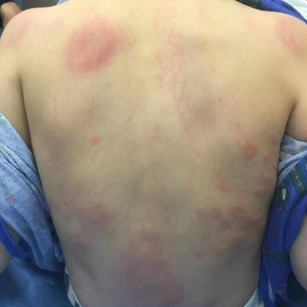 Urticaria on the back