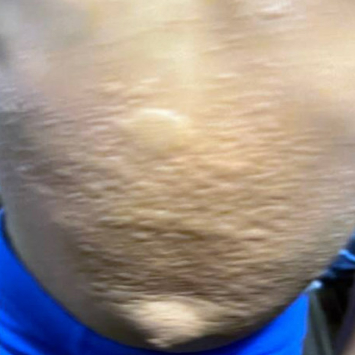 Urticaria on the stomach