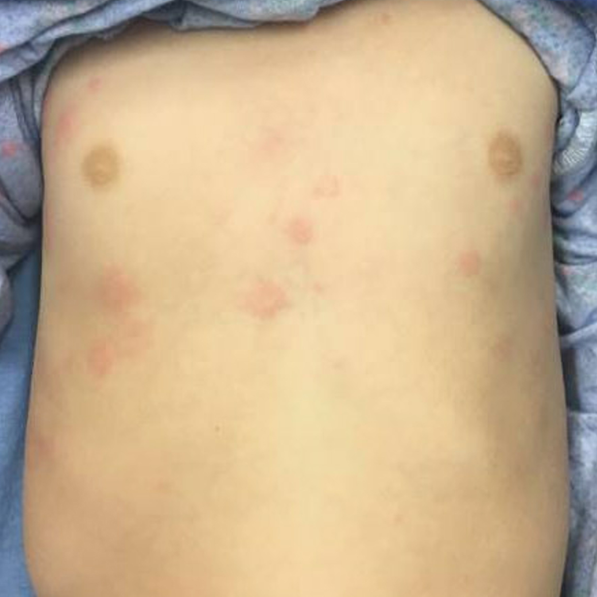 Urticaria on the chest