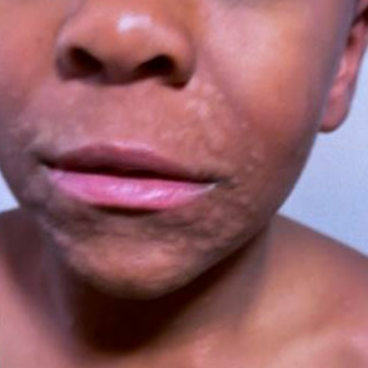 Urticaria on the face