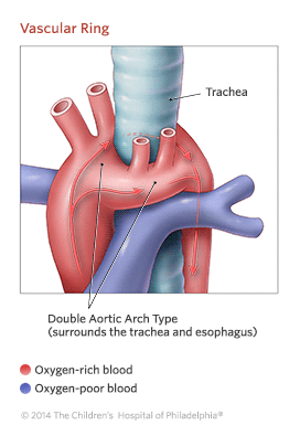 Vascular Ring Illustration