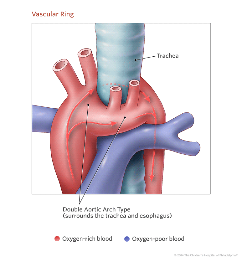 Vascular Ring Children's Hospital of Philadelphia