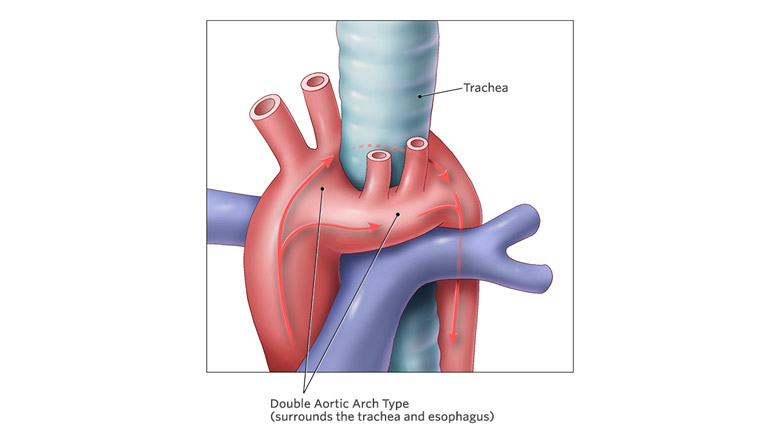 vascular ring illustration canonical