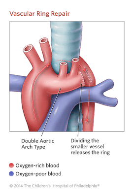 Vascular Ring Repair Illustration