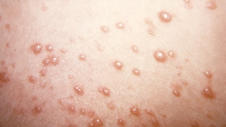 Image of rash bumps