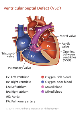 Ventricular Septal Defect Illustration