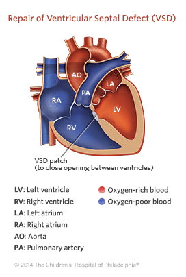 Repair of Ventricular Septal Defect Illustration