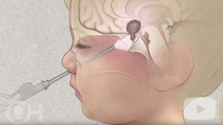 Endoscopic Neurosurgery for Children: Craniotomy Alternatives | Children's Hospital of Philadelphia Endoscopic Neurosurgery for Children: Craniotomy Alternatives | Children's Hospital of Philadelphia