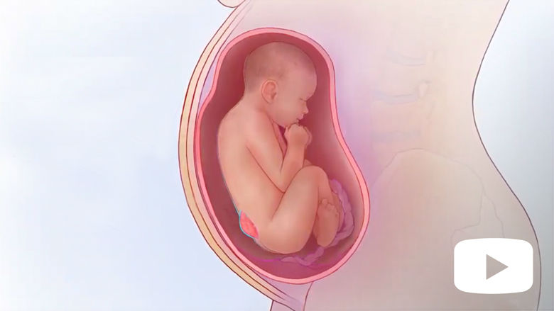 Born twice spina bifida
