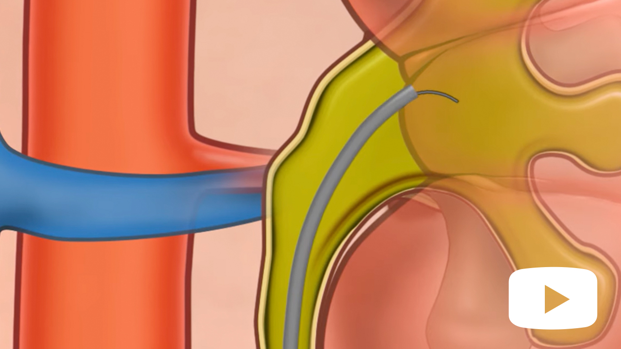 Ureteroscopy for Kidney Stones in Children Urology fellowship candidate speaking
