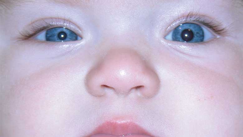 When Anisocoria Signals A Bigger Problem - Figure 1